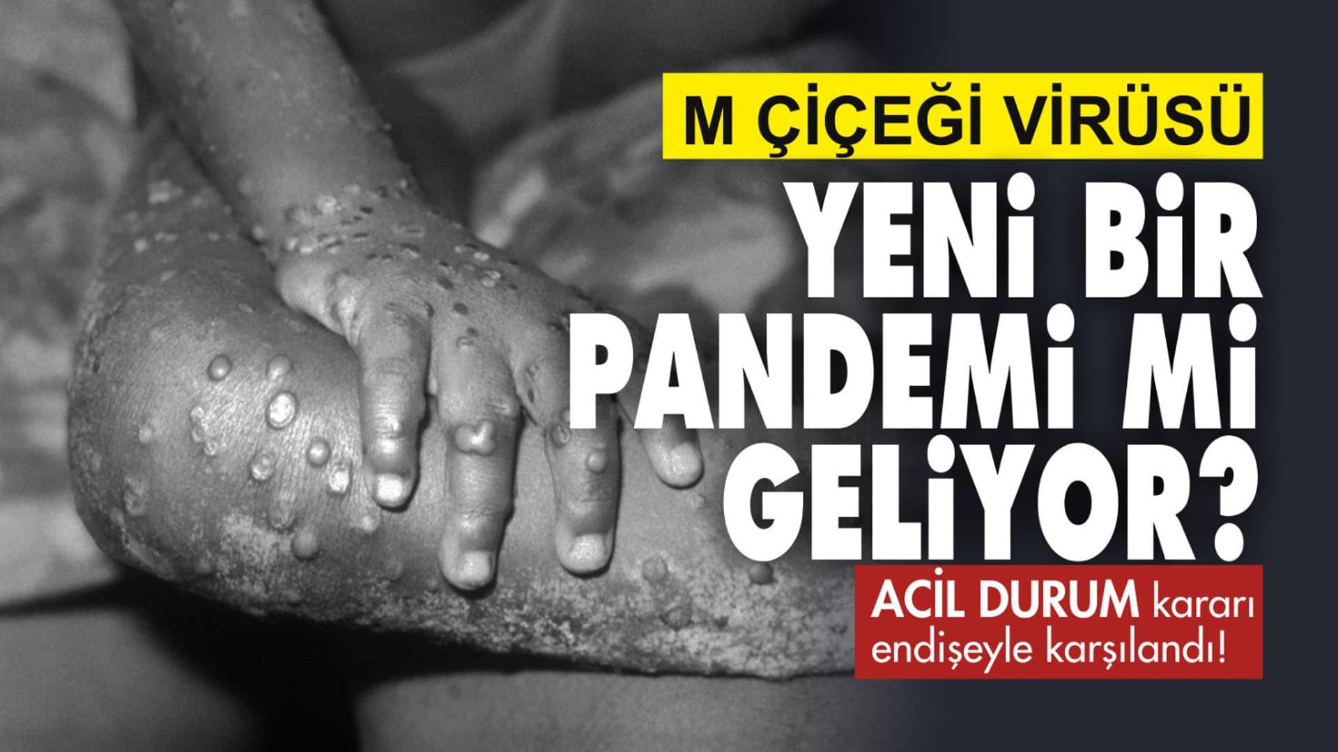 M Çiçeği virüsü küresel mercek altında!