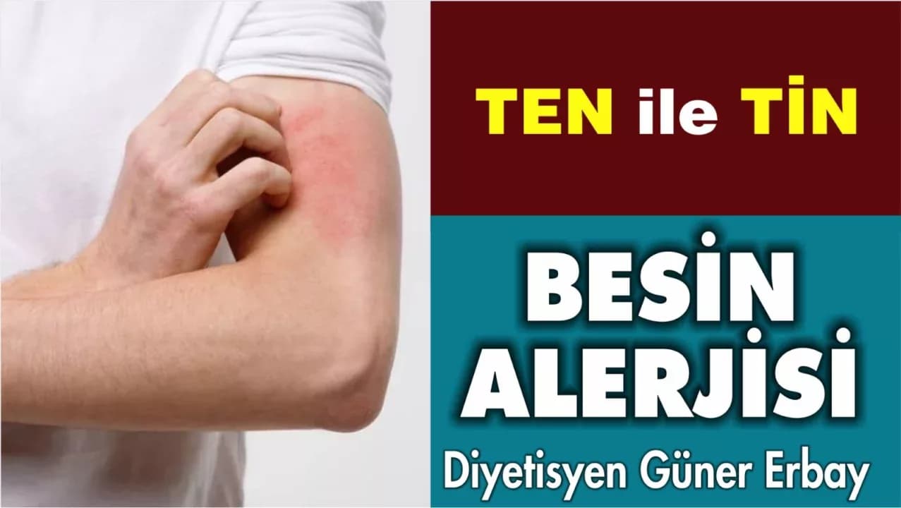 BESİN ALERJİLERİ