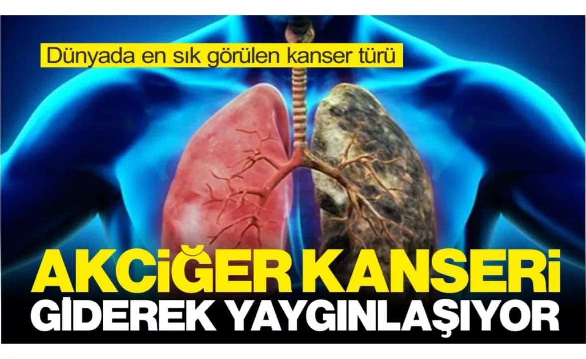 Dünyada En Sık Görülen Kanser Türü… Giderek Yaygınlaşıyor!