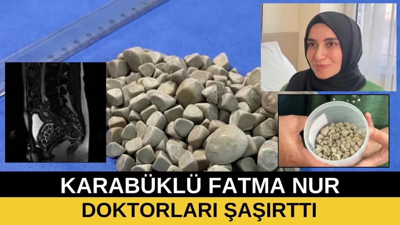 KARABÜKLÜ GENÇ KIZDAN 287 TAŞ ÇIKARILDI