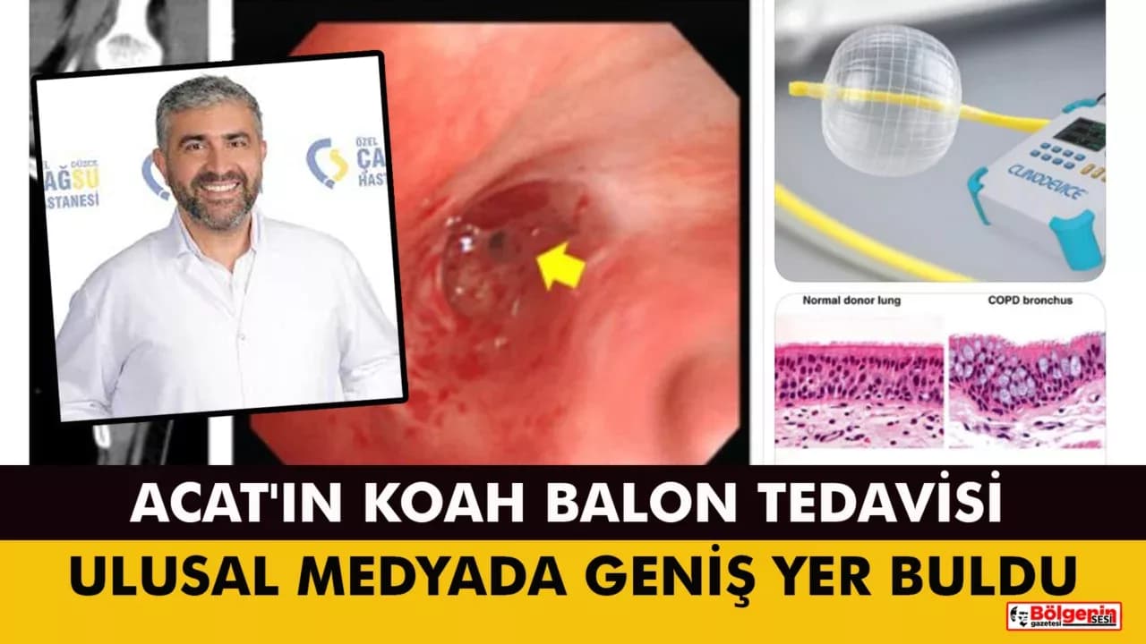 Acat'ın KOAH Balon Tedavisi Ulusal Medyada Geniş Yer Buldu